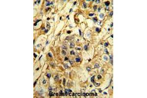 Formalin-fixed and paraffin-embedded human breast carcionma reacted with TIMP1 Antibody (N-term), which was peroxidase-conjugated to the secondary antibody, followed by DAB staining. (TIMP1 抗体  (N-Term))