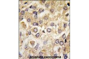 Forlin-fixed and paraffin-embedded hun prostata carcino tissue reacted with P2K2 Antibody  (ABIN6243254 and ABIN6579024) , which was peroxidase-conjugated to the secondary antibody, followed by DAB staining. (MEK2 抗体  (AA 372-400))