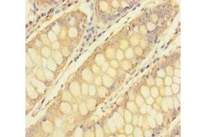 Immunohistochemistry of paraffin-embedded human colon cancer using ABIN7173639 at dilution of 1:100 (TULP3 抗体  (AA 1-260))