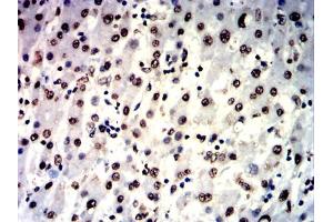 Immunohistochemical analysis of paraffin-embedded liver cancer tissues using IL1B mouse mAb with DAB staining. (IL-1 beta 抗体  (AA 117-269))