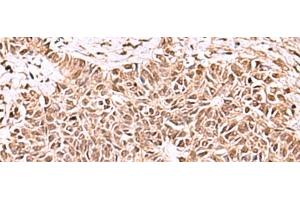 Immunohistochemistry of paraffin-embedded Human ovarian cancer tissue using ACTL6B Polyclonal Antibody at dilution of 1:100(x200) (Actin-Like 6B 抗体)