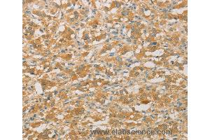 Immunohistochemistry of Human gastric cancer using PRPSAP1 Polyclonal Antibody at dilution of 1:50 (PRPSAP1 抗体)