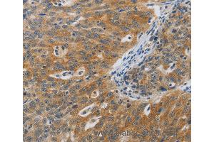 Immunohistochemistry of Human ovarian cancer using F2R Polyclonal Antibody at dilution of 1:40 (PAR1 抗体)