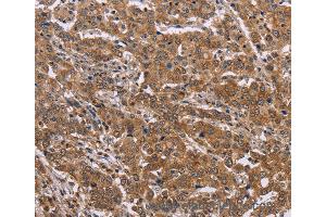 Immunohistochemistry of Human colon cancer using FAAH2 Polyclonal Antibody at dilution of 1:30 (FAAH2 抗体)