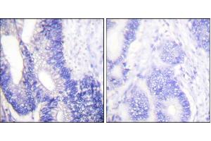 Immunohistochemical analysis of paraffin-embedded human colon carcinoma tissue using Claudin 3 antibody. (Claudin 3 抗体)