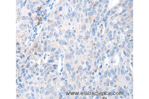 Immunohistochemistry of Human ovarian cancer using MAGEB4 Polyclonal Antibody at dilution of 1:40 (MAGEB4 抗体)