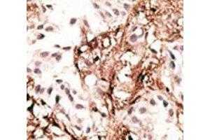 IHC analysis of FFPE human breast carcinoma tissue stained with the LC3C antibody (LC3C 抗体  (AA 1-30))