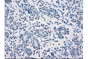 Immunohistochemical staining of paraffin-embedded breast tissue using anti-SORD mouse monoclonal antibody. (SORD 抗体)