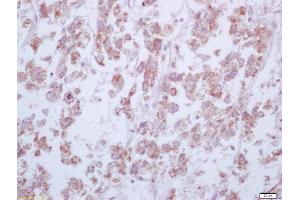 Formalin-fixed and paraffin embedded human liver carcinoma labeled with Anti-Arginase 1 Polyclonal Antibody, Unconjugated  at 1:200 followed by conjugation to the secondary antibody and DAB staining (Liver Arginase 抗体  (AA 151-220))