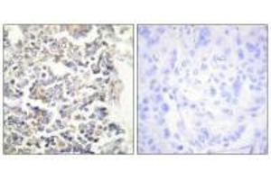Immunohistochemistry analysis of paraffin-embedded human lung carcinoma tissue using MARK3 antibody. (MARK3 抗体  (N-Term))