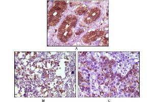 Immunohistochemical analysis of paraffin-embedded human breast tissue (A), lymph tissue (B) and skin carcinoma (C), showing membrane localization using BLK mouse mAb with DAB staining. (BLK 抗体)