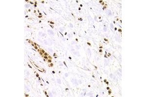 Immunohistochemistry of paraffin-embedded human gastric cancer using RAD50 Antibody. (RAD50 抗体)