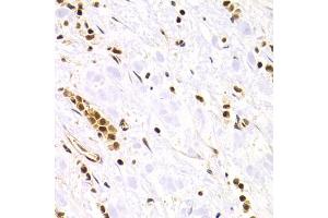 Immunohistochemistry of paraffin-embedded human gastric cancer using RAD50 Antibody.