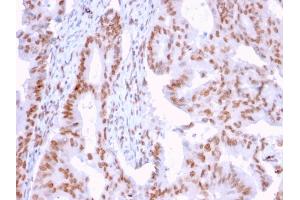 Formalin-fixed, paraffin-embedded human Breast Carcinoma stained with CLEC9A Mouse Monoclonal Antibody (2H12/4). (DMC1 抗体)