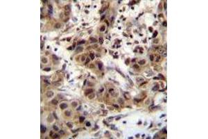 ZNF321 Antibody (N-term) immunohistochemistry analysis in formalin fixed and paraffin embedded human breast carcinoma followed by peroxidase conjugation of the secondary antibody and DAB staining. (ZNF321P 抗体  (N-Term))