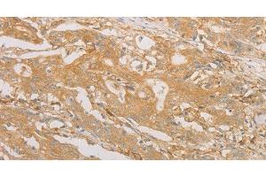Immunohistochemistry of paraffin-embedded Human gastric cancer tissue using CD40 Polyclonal Antibody at dilution 1:70 (CD40 抗体)