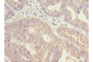 Immunohistochemistry of paraffin-embedded human endometrial cancer using ABIN7143769 at dilution of 1:100 (ALG2 抗体  (AA 197-416))
