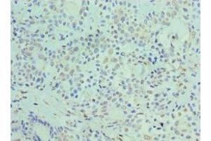 Immunohistochemistry of paraffin-embedded human breast cancer using ABIN7162890 at dilution of 1:100 (ADRP 抗体  (AA 168-437))
