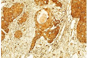 ABIN6266035 and ABIN6268862 at 1/100 staining Human esophageal cancer by IHC-P.