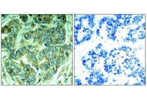 Immunohistochemical analysis of paraffin-embedded human breast carcinoma tissue using p62Dok(Phospho-Tyr398) Antibody(left) or the same antibody preincubated with blocking peptide(right). (DOK1 抗体  (pTyr398))