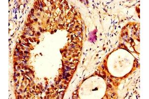 IHC image of ABIN7169337 diluted at 1:500 and staining in paraffin-embedded human cervical cancer performed on a Leica BondTM system. (SERPINB3 抗体  (AA 2-383))