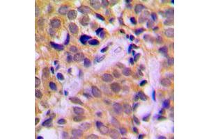Immunohistochemical analysis of CHRNA1 staining in human prostate cancer formalin fixed paraffin embedded tissue section. (CHRNA1 抗体  (Center))