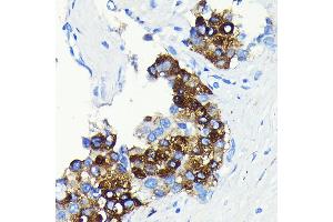 Immunohistochemistry of paraffin-embedded human liver cancer using C-Reactive Protein (C-Reactive Protein (CRP)) Rabbit mAb (ABIN7265972) at dilution of 1:100 (40x lens).
