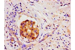 Immunohistochemistry of paraffin-embedded human breast cancer using ABIN7165746 at dilution of 1:100 (LIN28A 抗体  (AA 1-209))