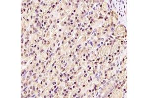 Immunohistochemistry of paraffin embedded human gastric cancer using DDX19B (ABIN7073694) at dilution of 1: 1000 (400x lens)