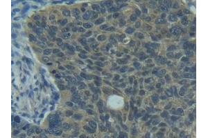 Detection of FASL in Human Esophagus cancer Tissue using Polyclonal Antibody to Factor Related Apoptosis Ligand (FASL)