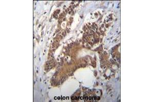 PCYT1A Antibody immunohistochemistry analysis in formalin fixed and paraffin embedded human colon carcinoma followed by peroxidase conjugation of the secondary antibody and DAB staining. (PCYT1A 抗体  (N-Term))
