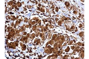 IHC-P Image MMP2 antibody detects MMP2 protein at cytosol and nucleus on human breast carcinoma by immunohistochemical analysis. (MMP2 抗体)
