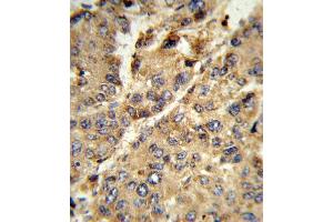 Formalin-fixed and paraffin-embedded human hepatocarcinoma reacted with XDH Antibody (N-term), which was peroxidase-conjugated to the secondary antibody, followed by DAB staining. (XDH 抗体  (N-Term))