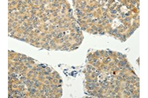 The image on the left is immunohistochemistry of paraffin-embedded Human liver cancer tissue using ABIN7128020(SPIN4 Antibody) at dilution 1/20, on the right is treated with fusion protein. (SPIN4 抗体)