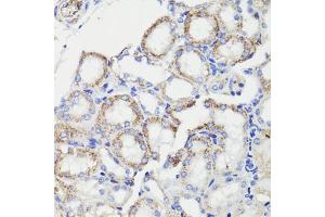 Immunohistochemistry of paraffin-embedded human breast cancer using PDCD10 antibody (ABIN7269540) at dilution of 1:100 (40x lens). (PDCD10 抗体  (AA 1-212))