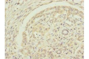 Immunohistochemistry of paraffin-embedded human pancreatic cancer using ABIN7151440 at dilution of 1:100 (EDIL3 抗体  (AA 60-300))