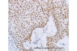 Immunohistochemistry of Human esophagus cancer using MCM2 Polyclonal Antibody at dilution of 1:50 (MCM2 抗体)