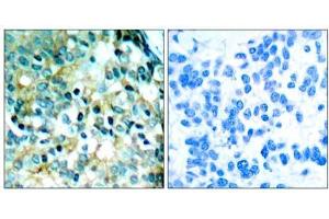 Immunohistochemical analysis of paraffin- embedded human breast carcinoma tissue using Src (phospho- Tyr418) antibody (E011091). (Src 抗体  (pTyr418))