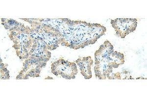 Immunohistochemistry of paraffin-embedded Human thyroid cancer tissue using FCGRT Polyclonal Antibody at dilution of 1:45(x200) (FcRn 抗体)