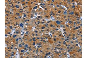 The image on the left is immunohistochemistry of paraffin-embedded Human liver cancer tissue using ABIN7130272(MSH5 Antibody) at dilution 1/30, on the right is treated with fusion protein. (MSH5 抗体)