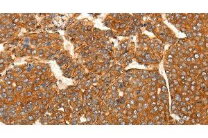 Immunohistochemistry of paraffin-embedded Human liver cancer tissue using SFRP1 Polyclonal Antibody at dilution 1:80 (SFRP1 抗体)