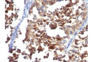 Formalin-fixed, paraffin-embedded human Melanoma stained with CD63 Mouse Monoclonal Antibody (LAMP3/968) (CD63 抗体)