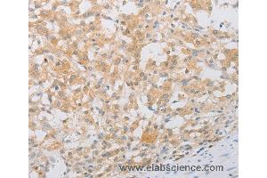 Immunohistochemistry of Human thyroid cancer using PDE4D Polyclonal Antibody at dilution of 1:20 (PDE4D 抗体)