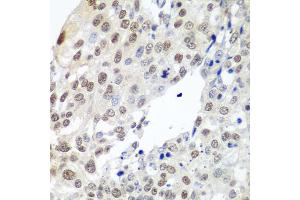 Immunohistochemistry of paraffin-embedded human lung cancer using PTTG1 antibody (ABIN5974823) at dilution of 1/100 (40x lens). (PTTG1 抗体)