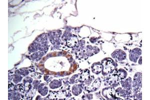 IHC-P Image Immunohistochemical analysis of human salivary gland cancer, using CAD, antibody at 1:100 dilution. (CAD 抗体  (C-Term))