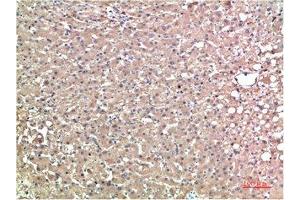 Immunohistochemical analysis of paraffin-embedded Human Liver Carcinoma Tissue using TTR Mouse mAb diluted at 1:200. (TTR 抗体)
