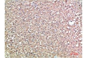 Immunohistochemical analysis of paraffin-embedded Human Liver Carcinoma Tissue using TTR Mouse mAb diluted at 1:200. (TTR 抗体)