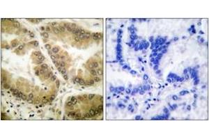 Immunohistochemistry analysis of paraffin-embedded human lung carcinoma tissue, using HDAC7 Antibody. (HDAC7 抗体  (AA 901-950))