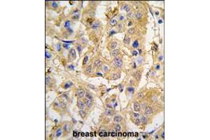 Formalin-fixed and paraffin-embedded human breast carcinoma tissue reacted with MIPEP antibody , which was peroxidase-conjugated to the secondary antibody, followed by DAB staining. (MIPEP 抗体  (AA 307-336))