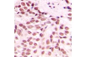 Immunohistochemical analysis of GADD153 staining in human breast cancer formalin fixed paraffin embedded tissue section. (DDIT3 抗体  (Center))